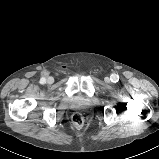 File:Amyand hernia (Radiopaedia 39300-41547 A 74).png