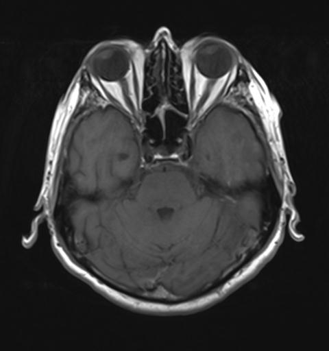 File:Amyloid angiopathy with inflammation (Radiopaedia 30360-31002 Axial T1 10).jpg