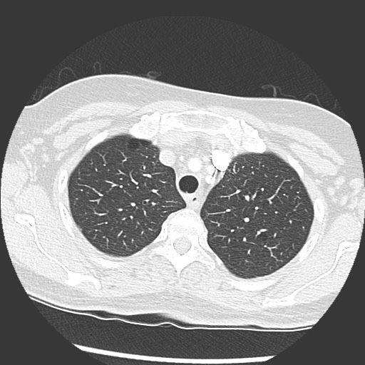 Amyloidosis - bronchial and diffuse nodular pulmonary involvement (Radiopaedia 60156-67745 Axial lung window 15).jpg