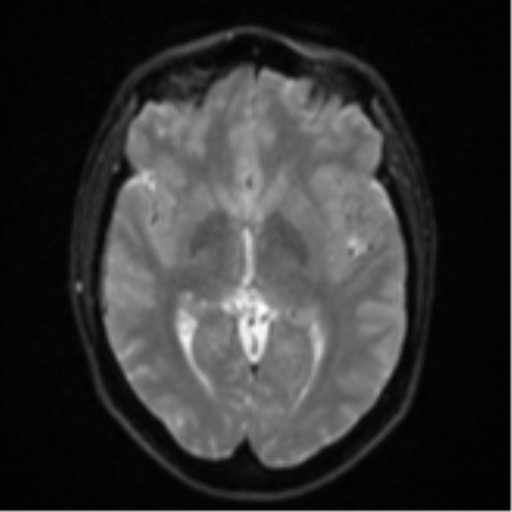 Anaplastic astrocytoma (Radiopaedia 57768-64731 Axial DWI 13).png
