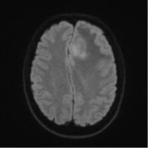 Anaplastic astrocytoma (Radiopaedia 57768-64731 Axial DWI 47).png