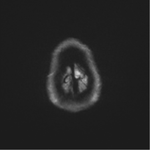 File:Anaplastic astrocytoma IDH mutant (Radiopaedia 50046-55341 Axial DWI 54).png