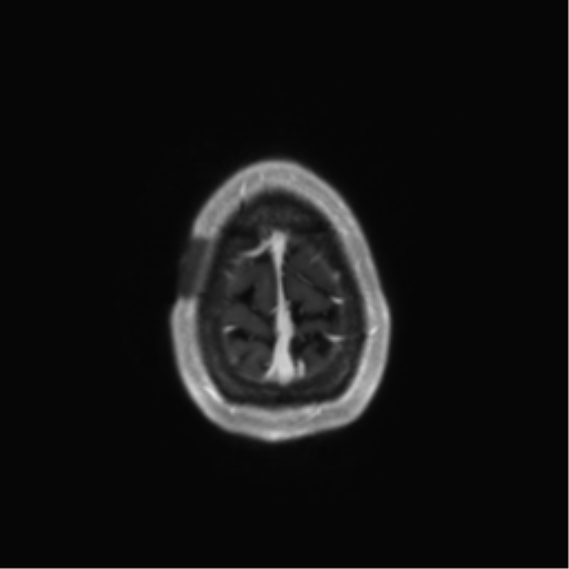 File:Anaplastic astrocytoma IDH mutant (Radiopaedia 50046-55341 Axial T1 C+ 46).png
