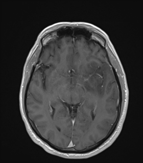 Anaplastic astrocytoma IDH wild-type (Radiopaedia 49984-55273 Axial T1 C+ 27).png