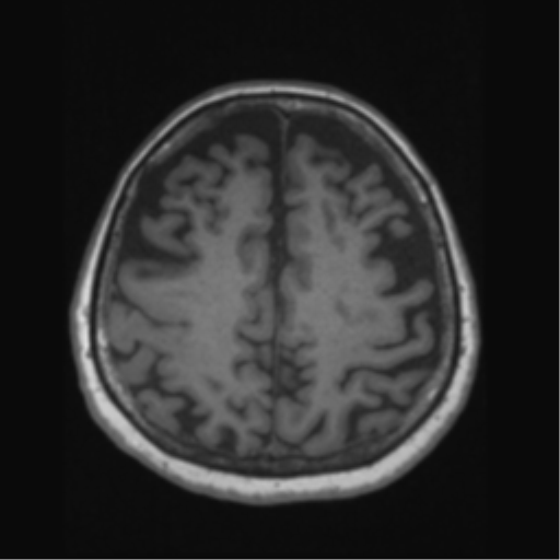 Anaplastic astrocytoma IDH wild-type (pseudoprogression) (Radiopaedia 42209-45276 Axial T1 110).png