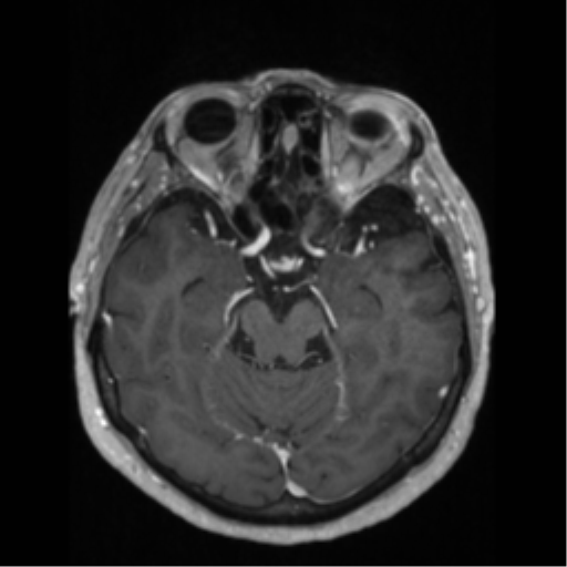 File:Anaplastic astrocytoma IDH wild-type (pseudoprogression) (Radiopaedia 42209-45276 Axial T1 C+ 59).png