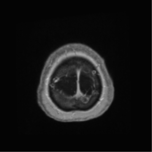 Anaplastic astrocytoma IDH wild-type (pseudoprogression) (Radiopaedia 42209-45278 Axial T1 C+ 145).png
