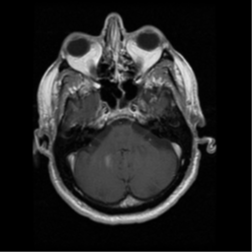 File:Anaplastic meningioma with recurrence (Radiopaedia 34452-35783 Axial T1 C+ 4).png