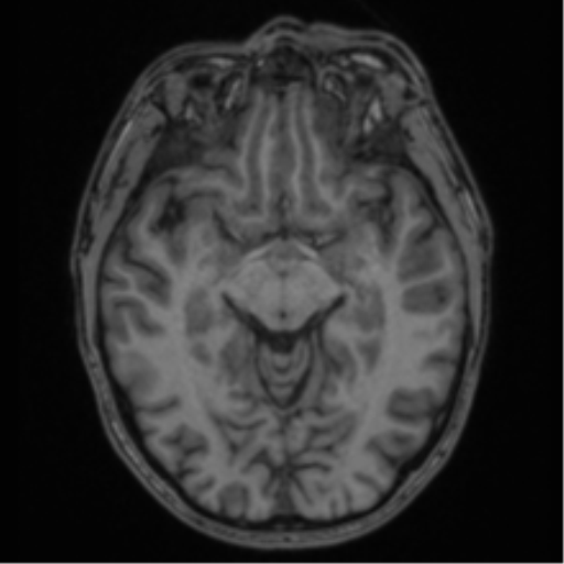 Anaplastic oligodendroglioma with skull fracture (Radiopaedia 74831-85845 Axial T1 26).png