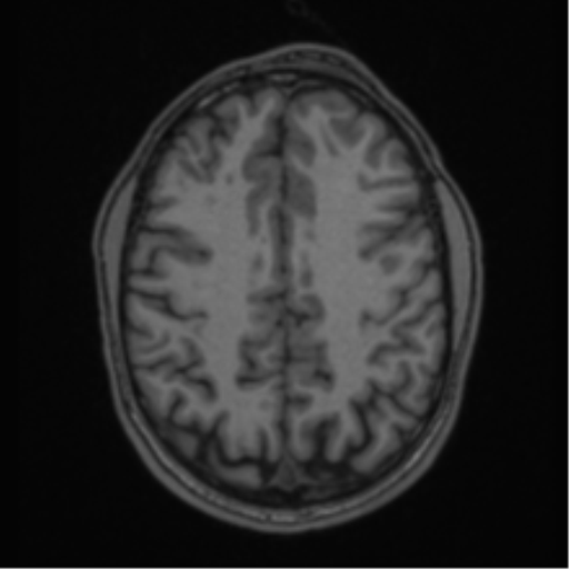 Anaplastic oligodendroglioma with skull fracture (Radiopaedia 74831-85845 Axial T1 46).png