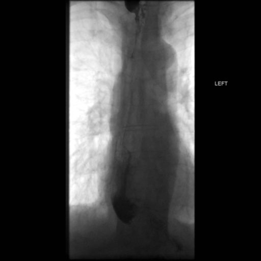 File:Anastomotic stricture post Ivor Lewis esophagectomy (Radiopaedia 47937-52715 B 48).png