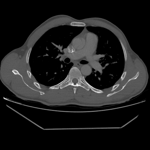 Aneurysmal bone cyst - rib (Radiopaedia 82167-96220 Axial bone window 122).jpg