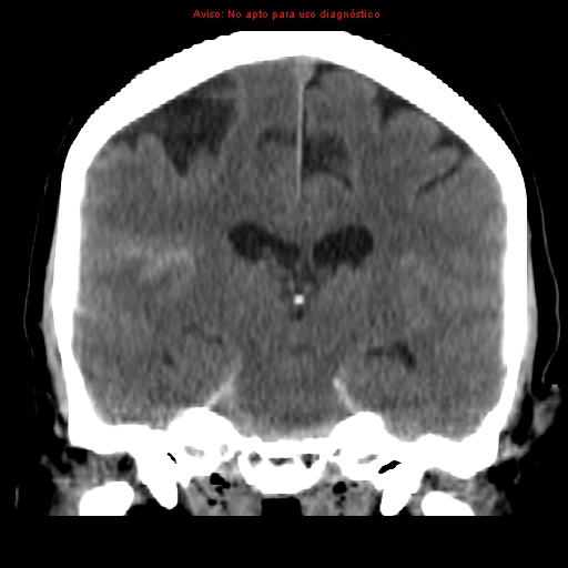 File:Aneurysmal subarachnoid hemorrhage (Radiopaedia 24740-24997 Coronal non-contrast 26).jpg