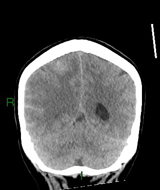 Aneurysmal subarachnoid hemorrhage with intra-axial extension (Radiopaedia 84371-99699 Coronal non-contrast 23).jpg