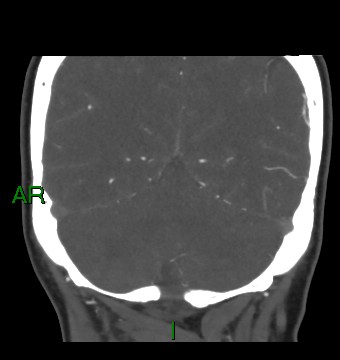 Aneurysmal subarachnoid hemorrhage with intra-axial extension (Radiopaedia 84371-99732 C 29).jpg