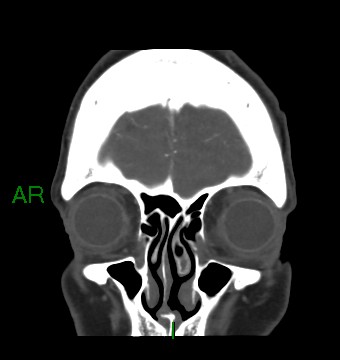 Aneurysmal subarachnoid hemorrhage with intra-axial extension (Radiopaedia 84371-99732 C 86).jpg