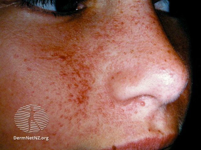 File:Angiofibromas in tuberous sclerosis (DermNet NZ systemic-angiofibromas-15).jpg