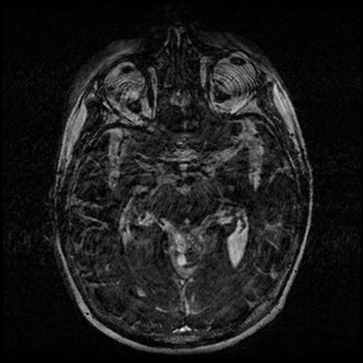 Angioinvasive aspergillosis in the pituitary fossa (Radiopaedia 39676-42010 Ax 3D FIESTA VOLUME 74).png