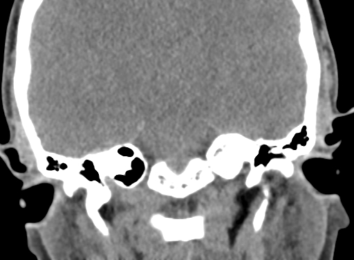 Angular dermoid cyst (Radiopaedia 88967-105790 Coronal non-contrast 72).jpg