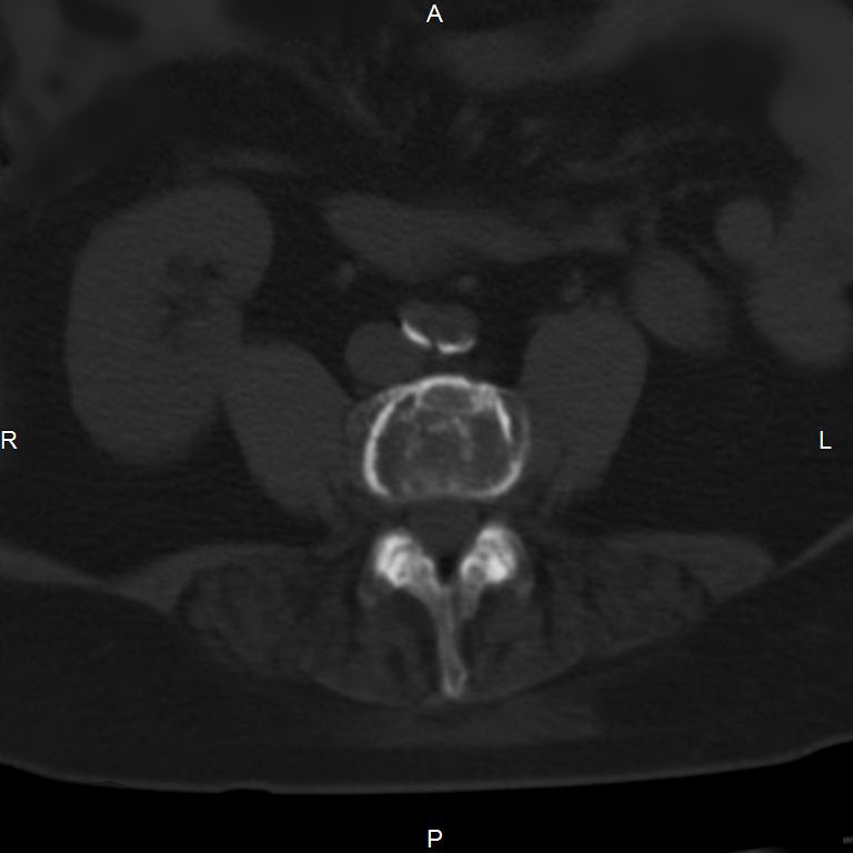 Ankylosing spondylitis (Radiopaedia 8748-9556 Axial bone window 36).jpg