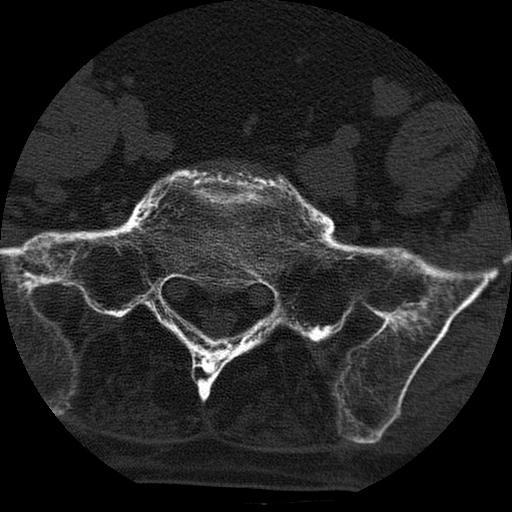 Ankylosing spondylitis complicated by fracture-dislocation (Radiopaedia 33583-34674 Axial non-contrast 151).jpg