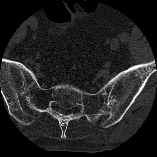 File:Ankylosing spondylitis complicated by fracture-dislocation (Radiopaedia 33583-34674 Axial non-contrast 174).jpg