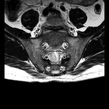 File:Ankylosing spondylitis with zygapophyseal arthritis (Radiopaedia 38433-40517 C 5).jpg