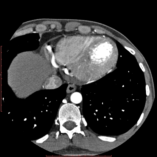 File:Anomalous left coronary artery from the pulmonary artery (ALCAPA) (Radiopaedia 70148-80181 A 322).jpg