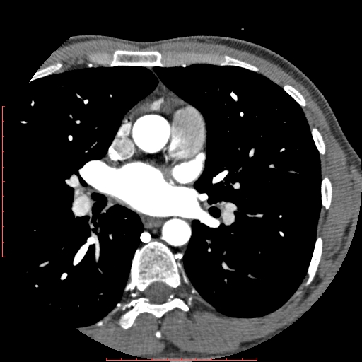File:Anomalous left coronary artery from the pulmonary artery (ALCAPA) (Radiopaedia 70148-80181 A 55).jpg