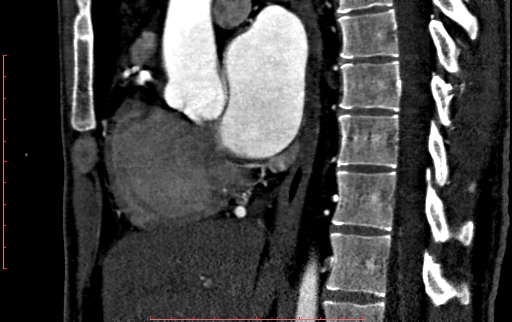 Anomalous left coronary artery from the pulmonary artery (ALCAPA) (Radiopaedia 70148-80181 C 104).jpg