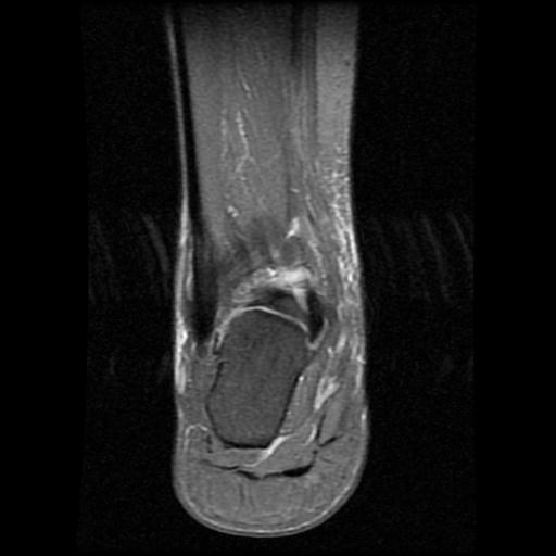 File:Anterior calcaneal process fracture (Radiopaedia 71377-81705 Coronal PD fat sat 12).jpg