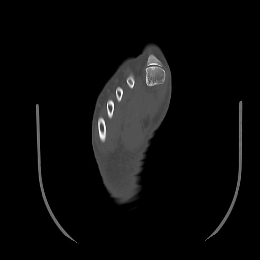 File:Anterior calcaneal process fracture (Radiopaedia 82590-96762 Axial bone window 39).jpg