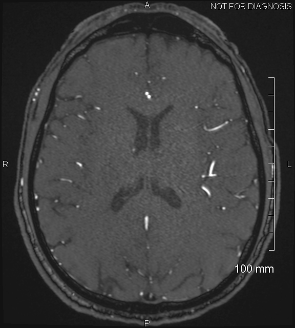 Anterior cerebral artery aneurysm (Radiopaedia 80683-94127 Axial MRA 148).jpg