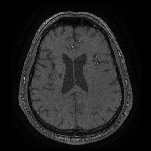 Anterior cerebral artery infarction (Radiopaedia 46794-51323 Axial MRA 145).jpg