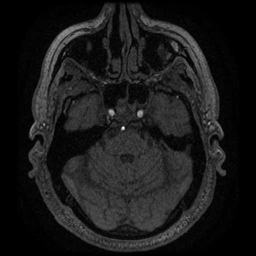 Anterior cerebral artery infarction (Radiopaedia 46794-51323 Axial MRA 39).jpg