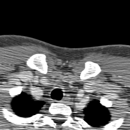 File:Anterior cerebral artery territory infarct (Radiopaedia 39327-41581 B 101).png