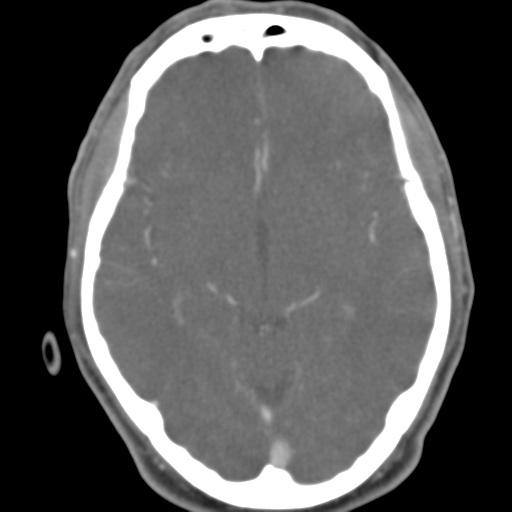 File:Anterior cerebral artery territory infarct (Radiopaedia 39327-41581 B 33).png