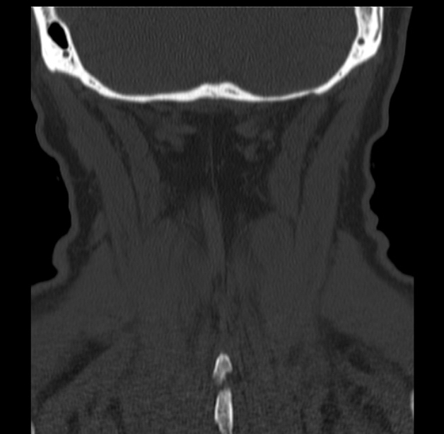 Anterior cervical postdiscectomy arthrodesis (Radiopaedia 32678-33646 Coronal bone window 64).jpg
