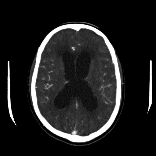 File:Anterior communicating artery aneurysm (Radiopaedia 16633-16335 A 26).jpg