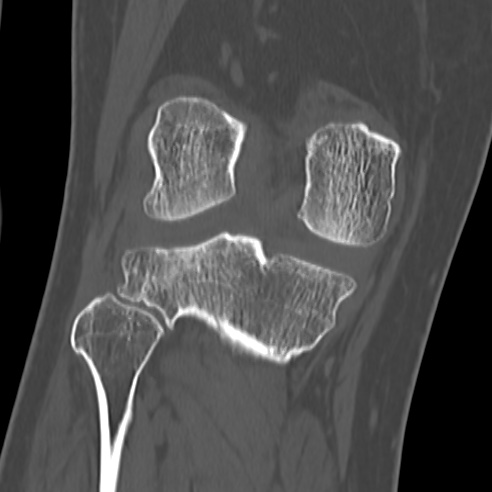File:Anterior cruciate ligament avulsion fracture (Radiopaedia 58939-66194 Coronal bone window 22).jpg