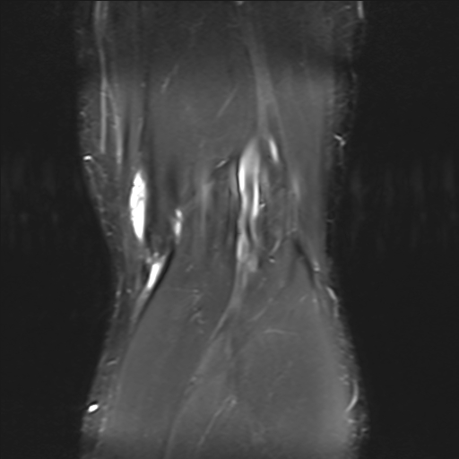 File:Anterior cruciate ligament full thickness tear (Radiopaedia 66268-75467 Coronal STIR 19).jpg