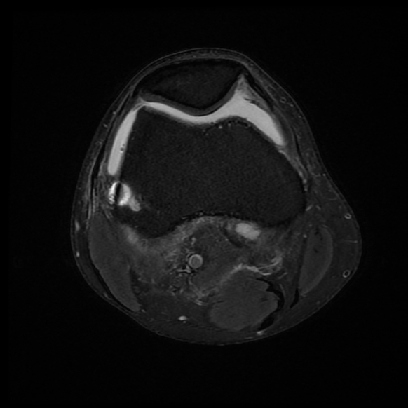 File:Anterior cruciate ligament graft tear and bucket-handle tear of medial meniscus (Radiopaedia 75867-87255 Axial PD fat sat 17).jpg