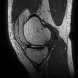 Anterior cruciate ligament rupture with Segond fracture (Radiopaedia 69043-78806 Sagittal PD 58).jpg