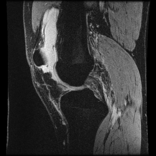 Anterior cruciate ligament tear (Radiopaedia 61500-69462 F 35).jpg