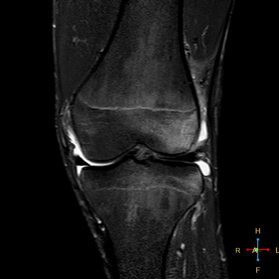 File:Anterior cruciate ligament tear - complete (Radiopaedia 24907-25170 Coronal STIR 10).jpg