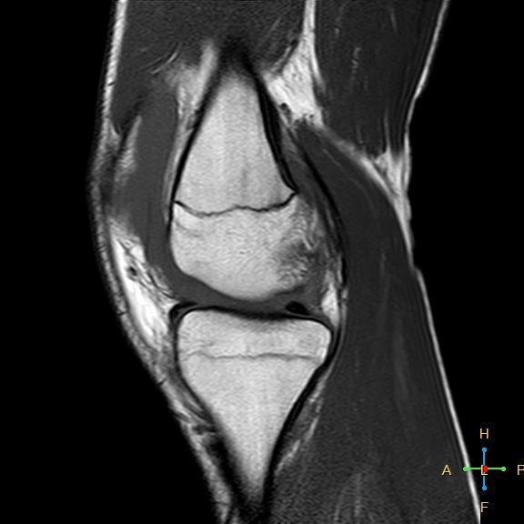 File:Anterior cruciate ligament tear - complete (Radiopaedia 24907-25170 Sagittal T1 12).jpg