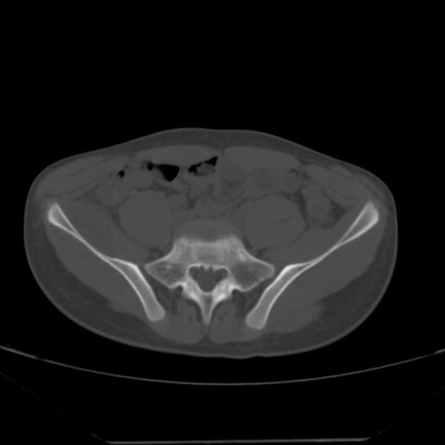 Anterior inferior iliac spine avulsion fracture (Radiopaedia 49469-54627 Axial bone window 7).jpg