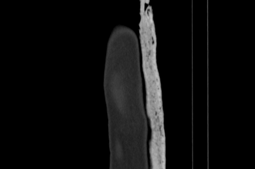Anterior inferior iliac spine avulsion injury (Radiopaedia 88666-105376 Sagittal bone window 6).jpg