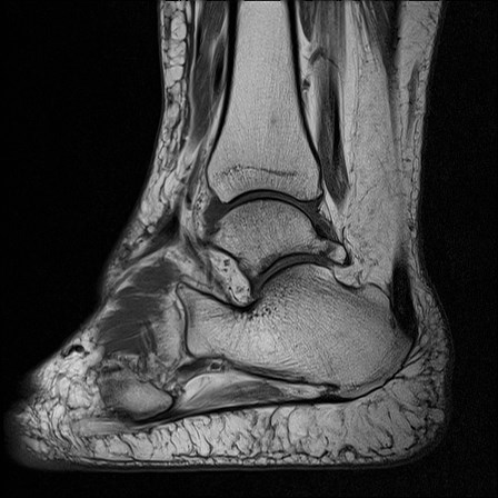 File:Anterior talofibular ligament injury - rupture with soft-tissue impingement (Radiopaedia 38765-40928 Sagittal PD 12).jpg