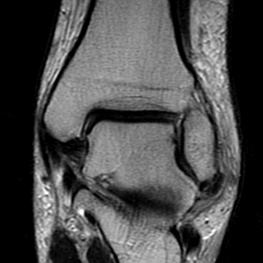 File:Anterior talofibular ligament rupture (Radiopaedia 15831-15484 Coronal T2 12).jpg